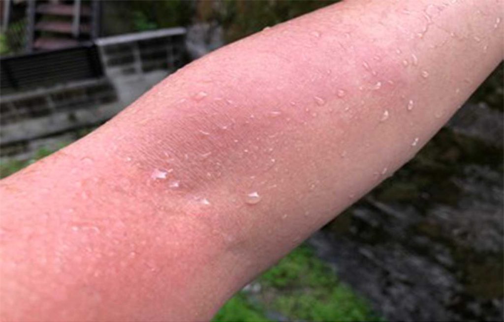 Water allergy on the elbow of a white man