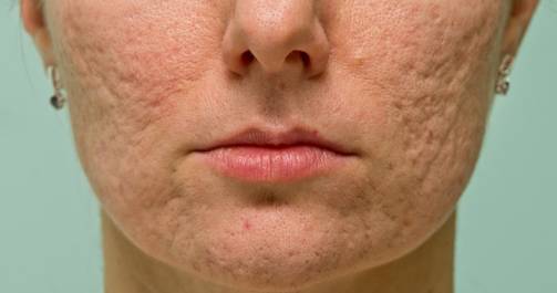 atrophic acne scars