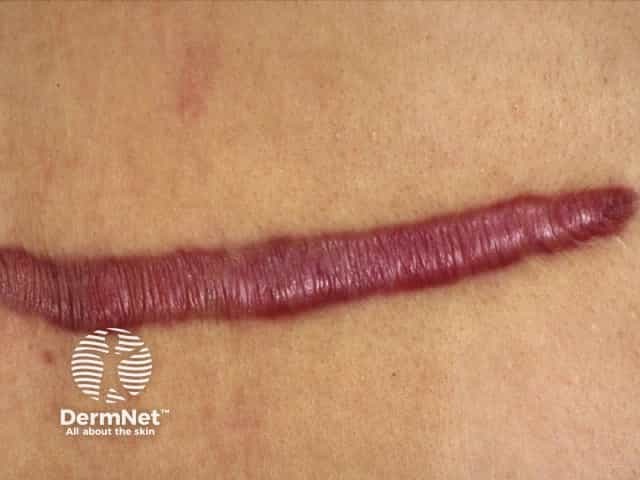 Hypertrophic scar