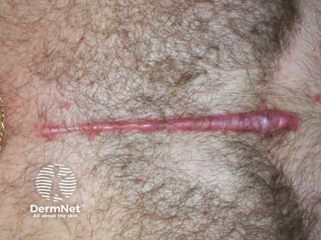 Hypertrophic scar