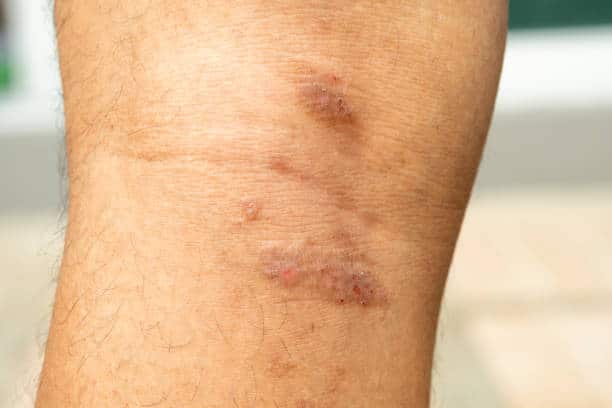 Fungal skin infection image