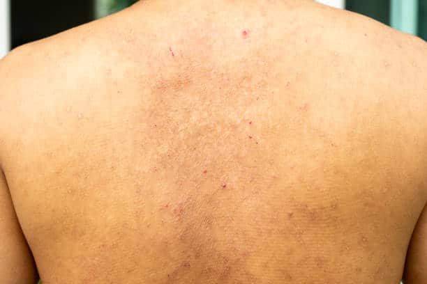 Skin hypersensitivity of the back