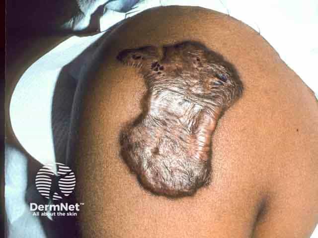 keloid