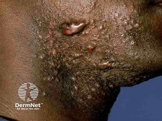 keloid