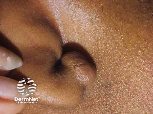 keloid