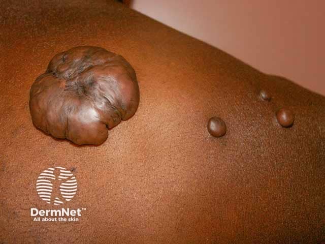 keloid