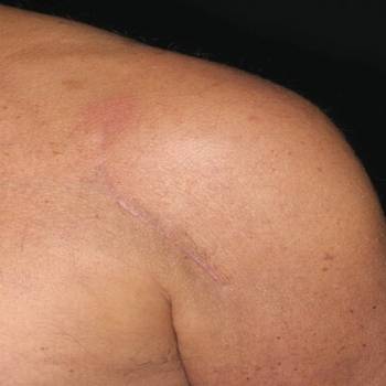 onion extract for scar removal