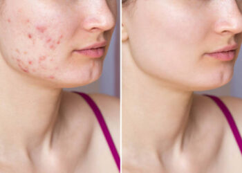 scar removal before and after