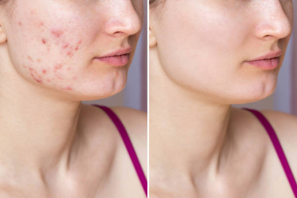 scar removal before and after