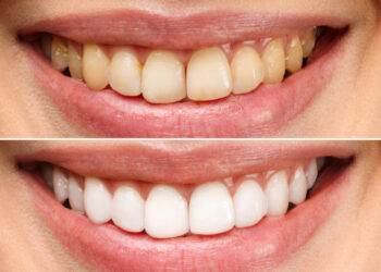 Before and after teeth whitening