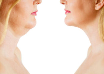 before and after face fat transformation