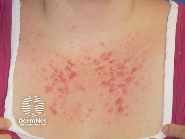 Polymorphic light eruption (PMLE) rash on sun-exposed skin