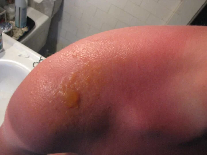Severe sunburn with fluid-filled blisters on the shoulder