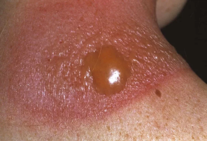 Severe sunburn with fluid-filled blisters on the shoulder