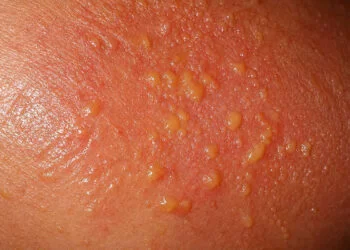 blisters in severe sunburn