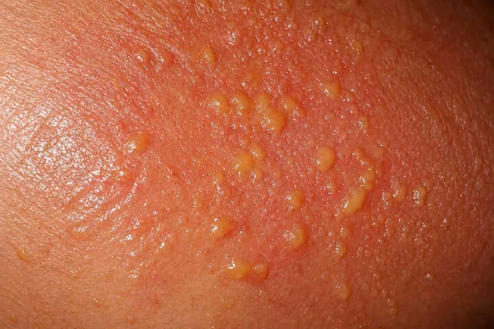 blisters in severe sunburn