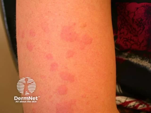 Solar urticaria with raised wheals after sun exposure